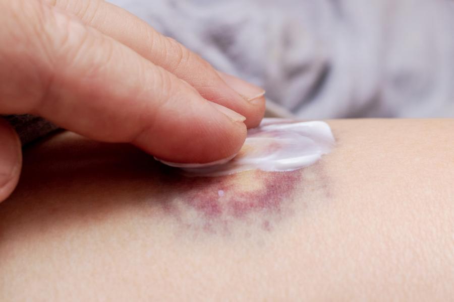 Causes des hématomes chez les personnes âgées